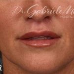 Lip Lift Before & After Patient #961