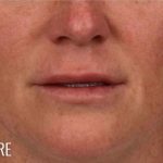 Lip Lift Before & After Patient #961