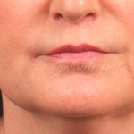 Lip Lift Before & After Patient #978