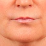 Lip Lift Before & After Patient #978