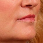 Lip Lift Before & After Patient #978