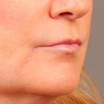 Lip Lift Before & After Patient #978