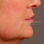 Lip Lift Before & After Patient #978