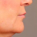 Lip Lift Before & After Patient #978