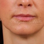 Lip Lift Before & After Patient #977
