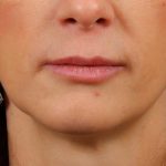 Lip Lift Before & After Patient #977