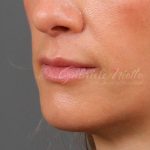 Lip Lift Before & After Patient #977
