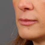 Lip Lift Before & After Patient #977