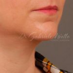Lip Lift Before & After Patient #976