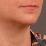 Lip Lift Before & After Patient #976