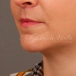 Lip Lift Before & After Patient #976