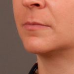 Lip Lift Before & After Patient #976