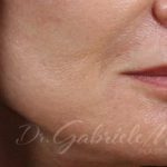 Lip Lift Before & After Patient #975