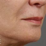 Lip Lift Before & After Patient #975