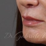 Lip Lift Before & After Patient #975