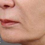 Lip Lift Before & After Patient #975