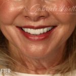 Lip Lift Before & After Patient #974