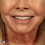 Lip Lift Before & After Patient #974