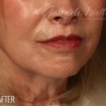 Lip Lift Before & After Patient #974