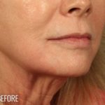 Lip Lift Before & After Patient #974