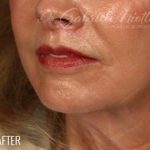 Lip Lift Before & After Patient #974