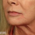 Lip Lift Before & After Patient #974