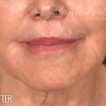 Lip Lift Before & After Patient #973