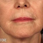 Lip Lift Before & After Patient #973