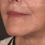 Lip Lift Before & After Patient #973