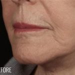 Lip Lift Before & After Patient #973
