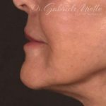 Lip Lift Before & After Patient #973