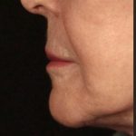 Lip Lift Before & After Patient #973
