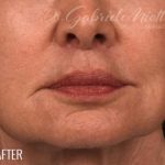 Lip Lift Before & After Patient #972