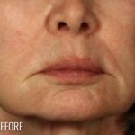 Lip Lift Before & After Patient #972