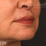 Lip Lift Before & After Patient #972