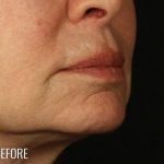 Lip Lift Before & After Patient #972