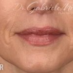 Lip Lift Before & After Patient #966
