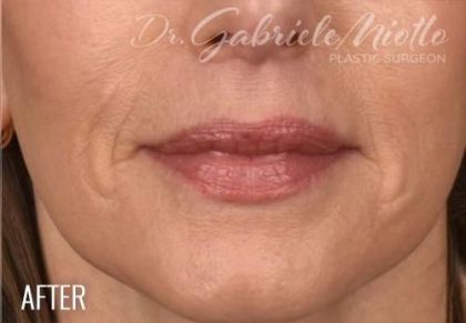 Lip Lift Before & After Patient #966