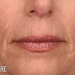 Lip Lift Before & After Patient #966