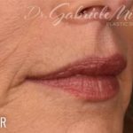 Lip Lift Before & After Patient #966