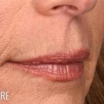 Lip Lift Before & After Patient #966