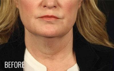 Neck Lift Before & After Patient #1159