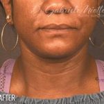 Neck Lift Before & After Patient #1127