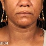 Neck Lift Before & After Patient #1127