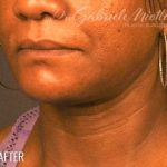 Neck Lift Before & After Patient #1127