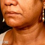 Neck Lift Before & After Patient #1127