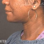 Neck Lift Before & After Patient #1127
