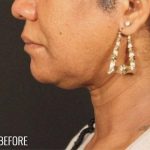 Neck Lift Before & After Patient #1127