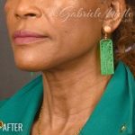 Neck Lift Before & After Patient #1161