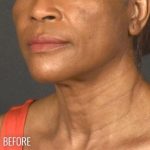 Neck Lift Before & After Patient #1161